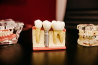 Your Employer Doesn’t Pay for Dental Insurance - Is it Worth Buying?